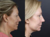 Deep Chemical Peel case #11008 slider thumbnail