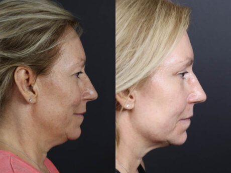 Deep Chemical Peel case #11008