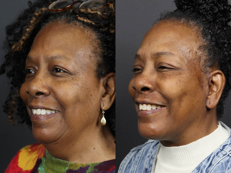 Facelift case #11058