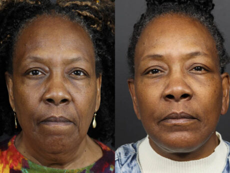 Facelift case #11058