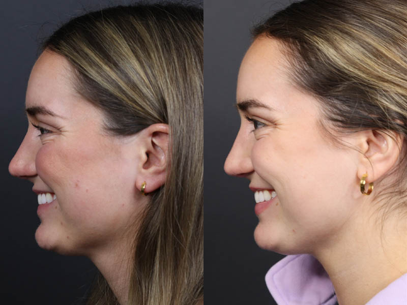 Revision Rhinoplasty case #11231