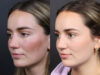 Revision Rhinoplasty case #11231 slider thumbnail