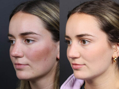 Revision Rhinoplasty case #11231