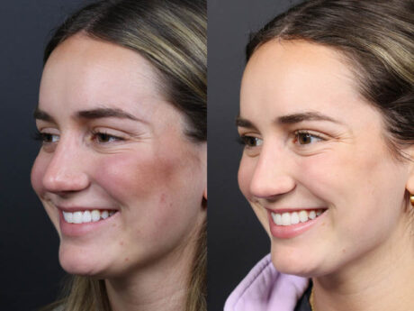 Revision Rhinoplasty case #11231