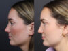 Revision Rhinoplasty case #11231 slider thumbnail