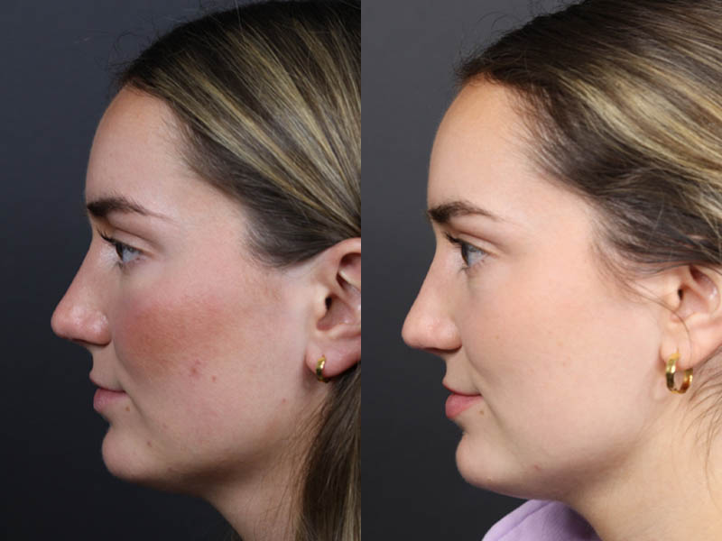 Revision Rhinoplasty case #11231