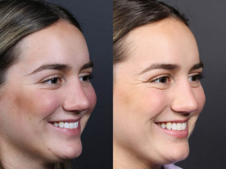 Revision Rhinoplasty case #11231