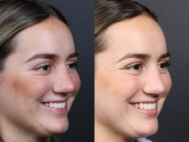 Revision Rhinoplasty case #11231