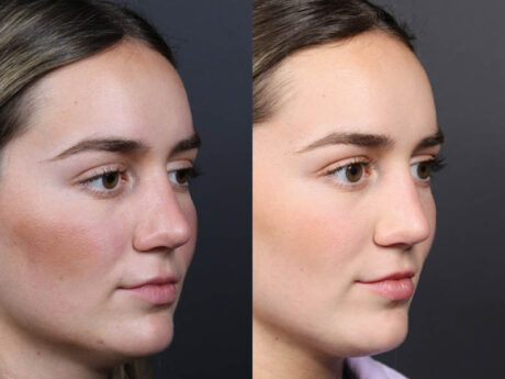 Revision Rhinoplasty case #11231