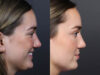 Revision Rhinoplasty case #11231 slider thumbnail