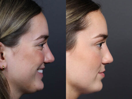 Revision Rhinoplasty case #11231