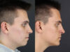 Chin Augmentation case #11184 slider thumbnail