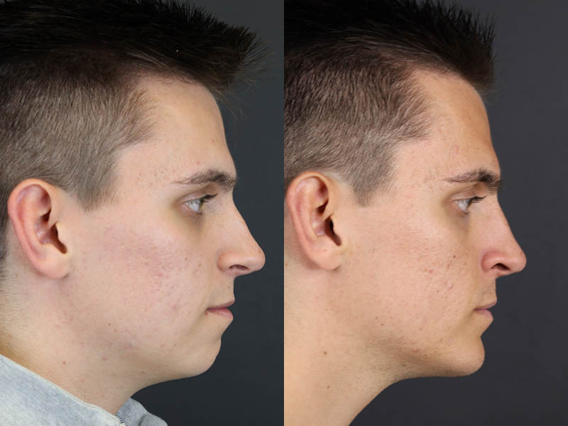Chin Augmentation case #11184
