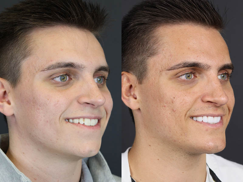 Chin Augmentation case #11184