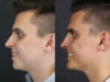 Chin Augmentation case #11184 slider thumbnail