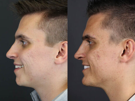 Chin Augmentation case #11184