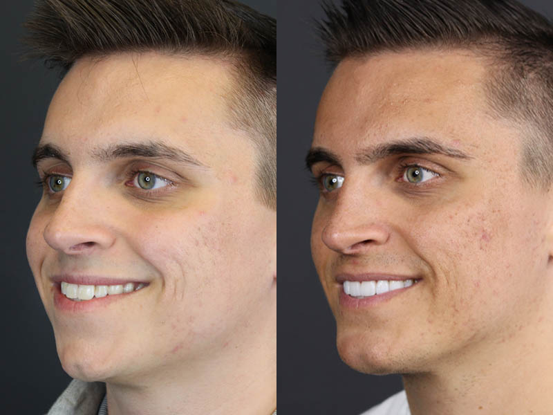 Chin Augmentation case #11184