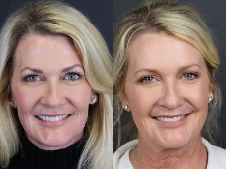 Deep Chemical Peel case #11201