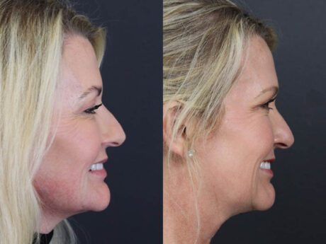 Deep Chemical Peel case #11201