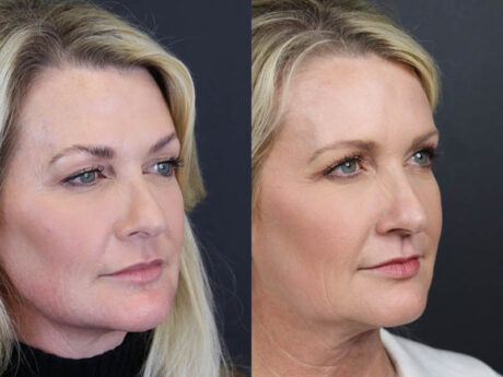 Deep Chemical Peel case #11201