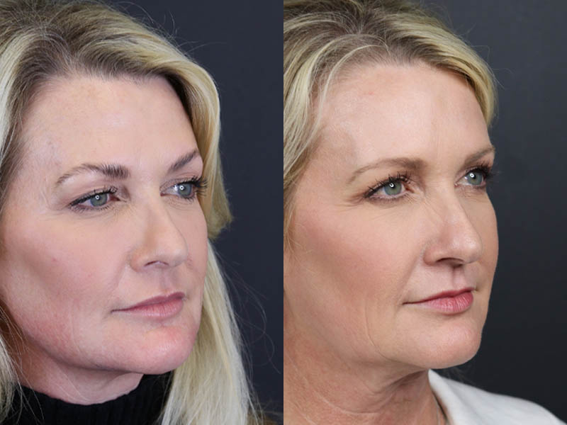 Deep Chemical Peel case #11201