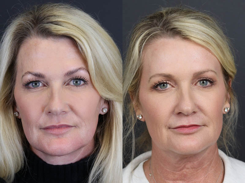 Deep Chemical Peel case #11201