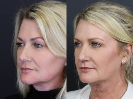 Deep Chemical Peel case #11201