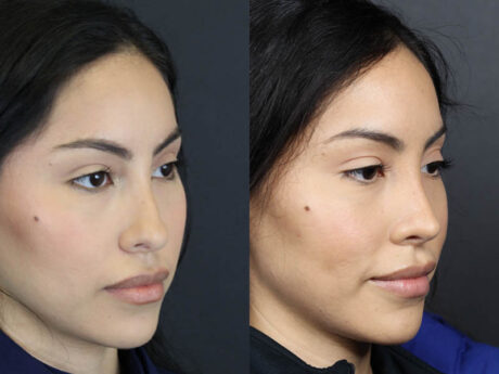 Rhinoplasty case #11209