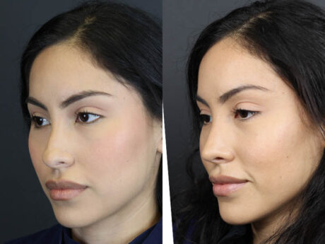 Rhinoplasty case #11209