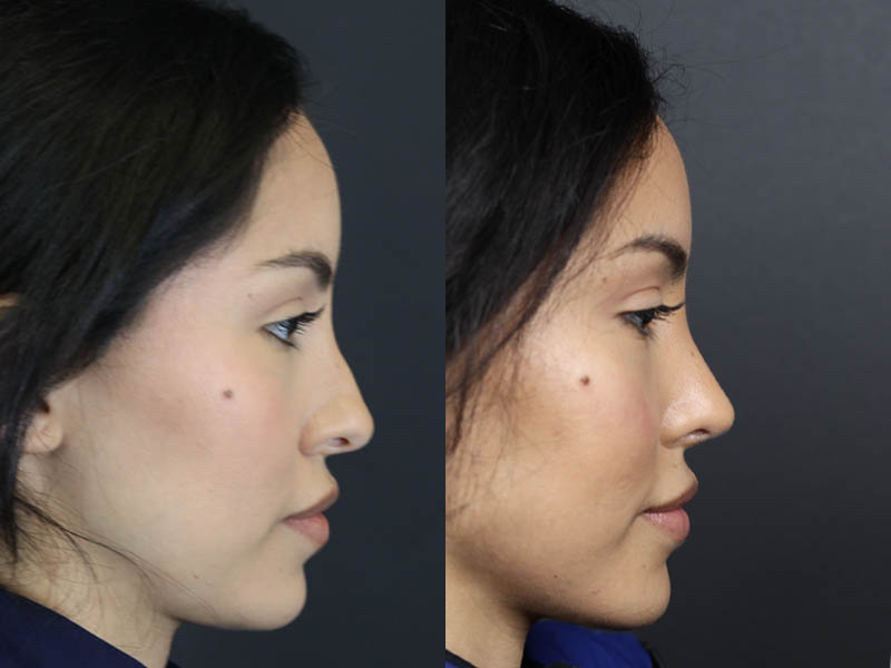 Rhinoplasty case #11209