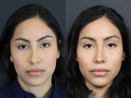 Rhinoplasty case #11209