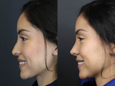 Rhinoplasty case #11209