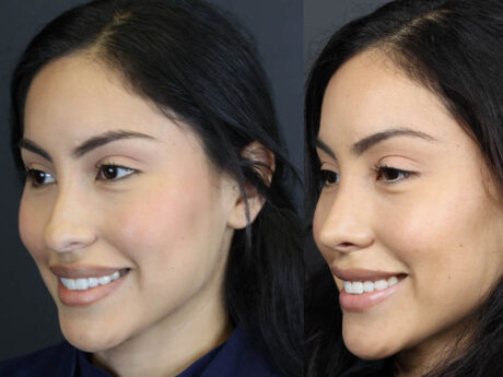 Rhinoplasty case #11209