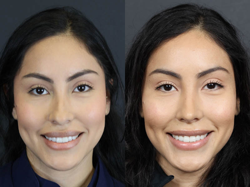 Rhinoplasty case #11209