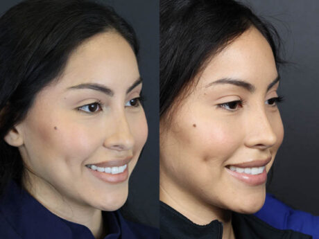 Rhinoplasty case #11209