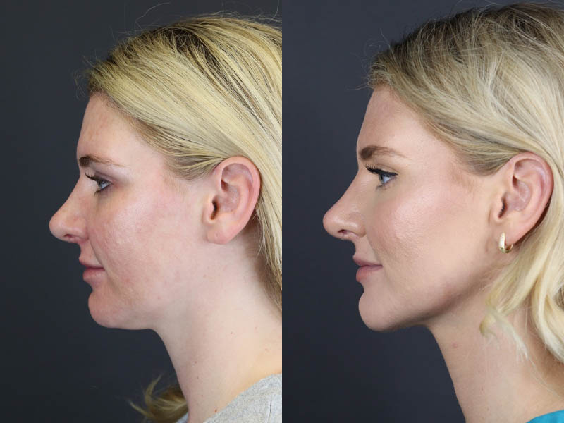 Liposuction case #11218