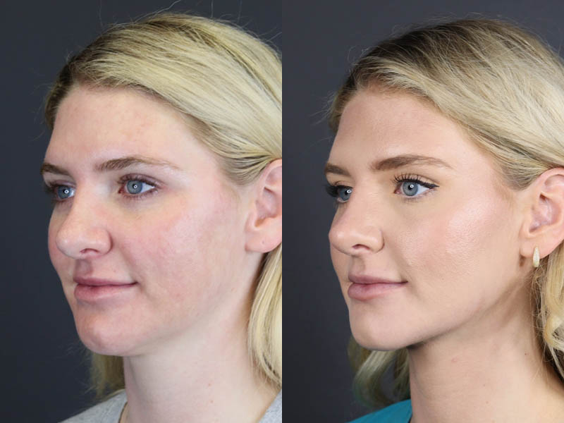 Liposuction case #11218