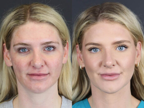 Liposuction case #11218