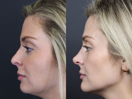 Liquid Rhinoplasty case #11224