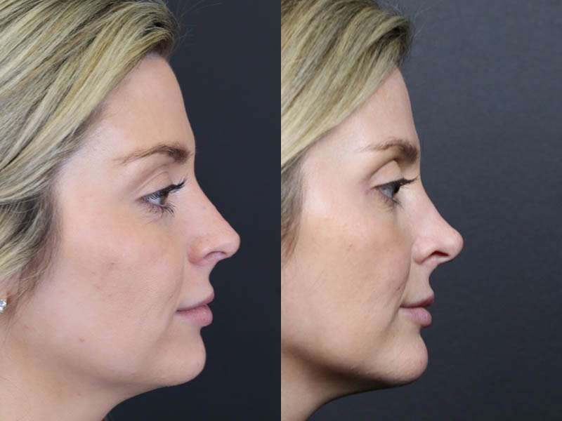 Liquid Rhinoplasty case #11224