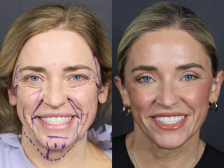 Facelift case #11314