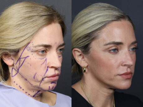 Facelift case #11314