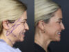 Facelift case #11314 slider thumbnail