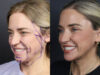 Facelift case #11314 slider thumbnail