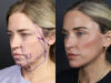 Facelift case #11314 slider thumbnail