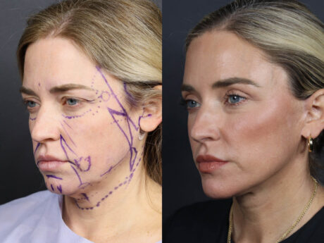 Facelift case #11314