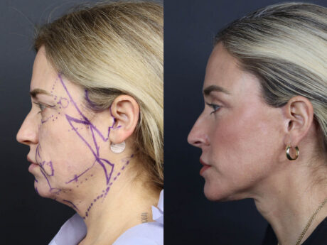 Facelift case #11314