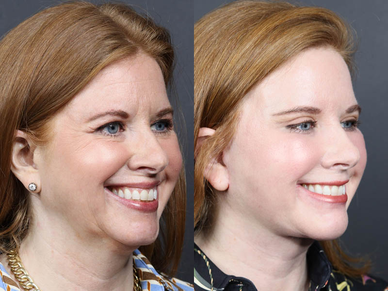 C02 Laser case #11308