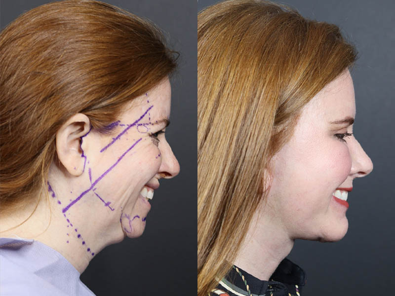 C02 Laser case #11308