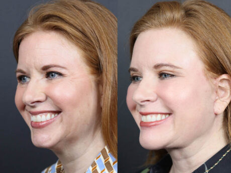 C02 Laser case #11308